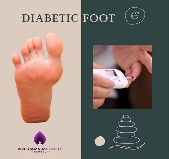 Diabetic Foot - A Complication of diabetes