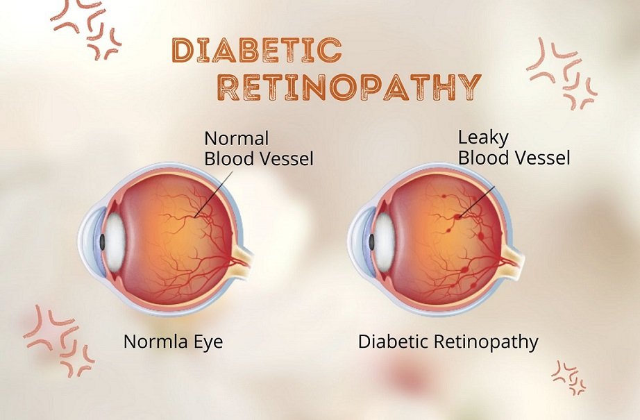 Retinal Diabetic Complications