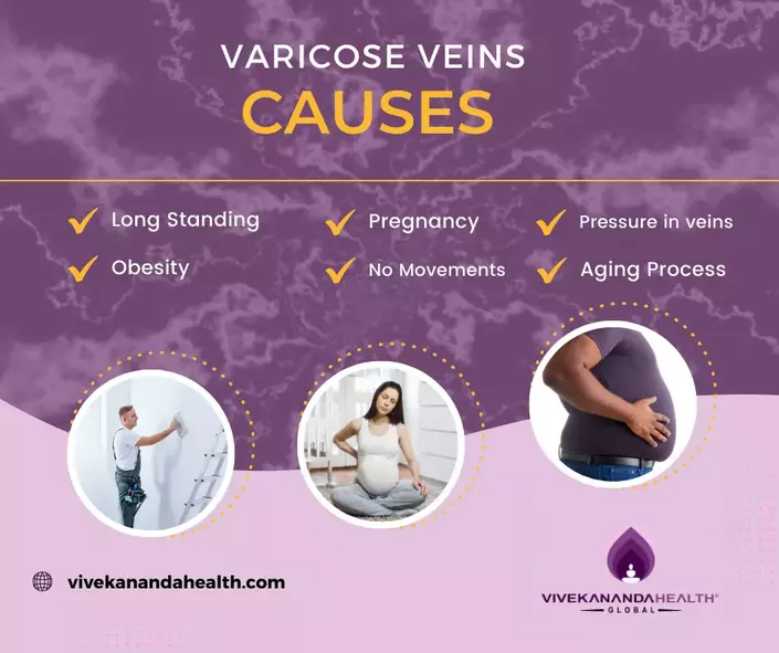 Causes of Varicose