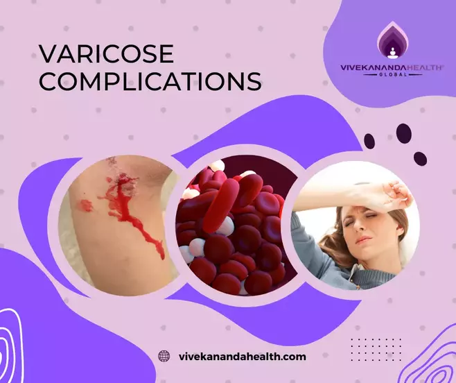 Complications of Varicose